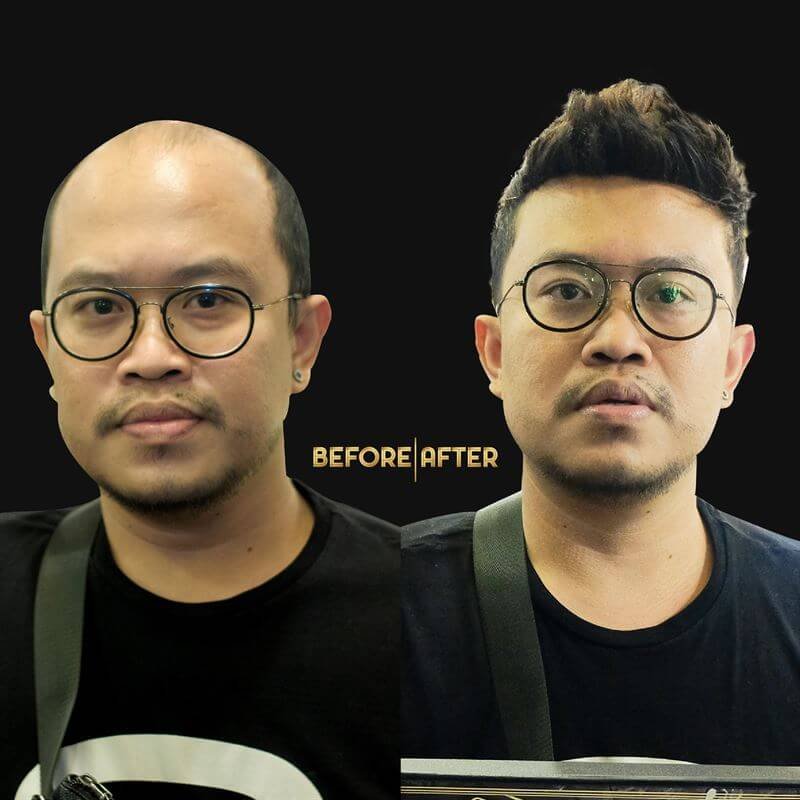Cara Memperkuat Folikel Rambut Pada Pria